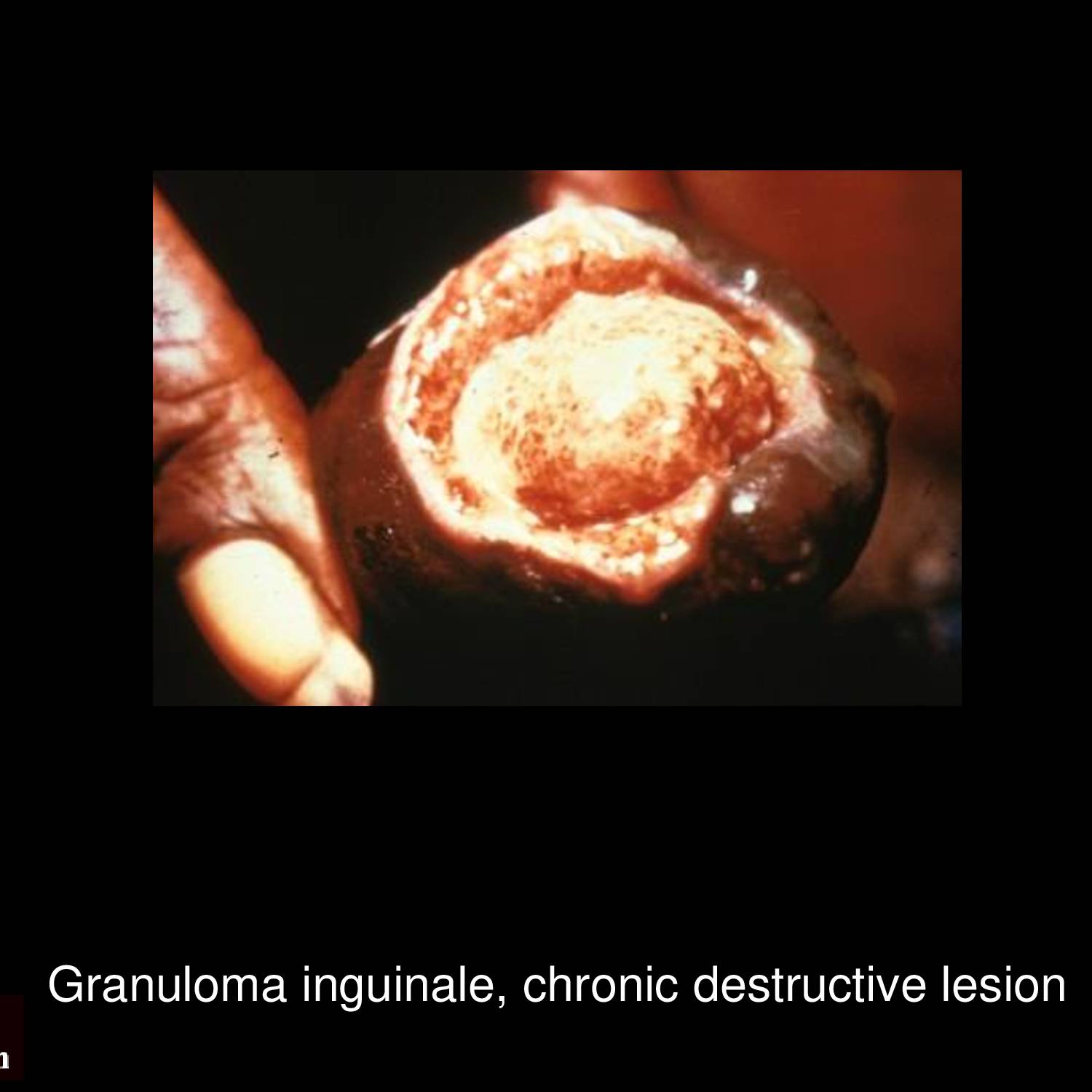 Advanced granuloma inguinale with extensive tissue destruction and scarring showing progressive ulcerative lesions in genital region